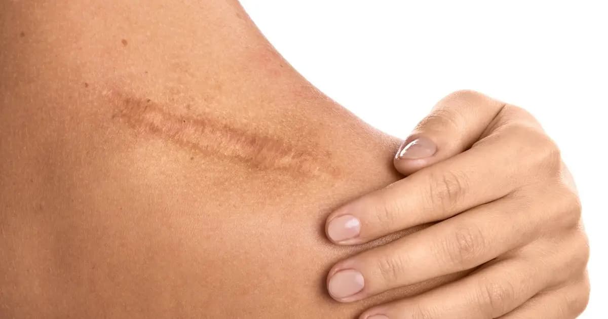 The Science of Scar Tissue Mobilization