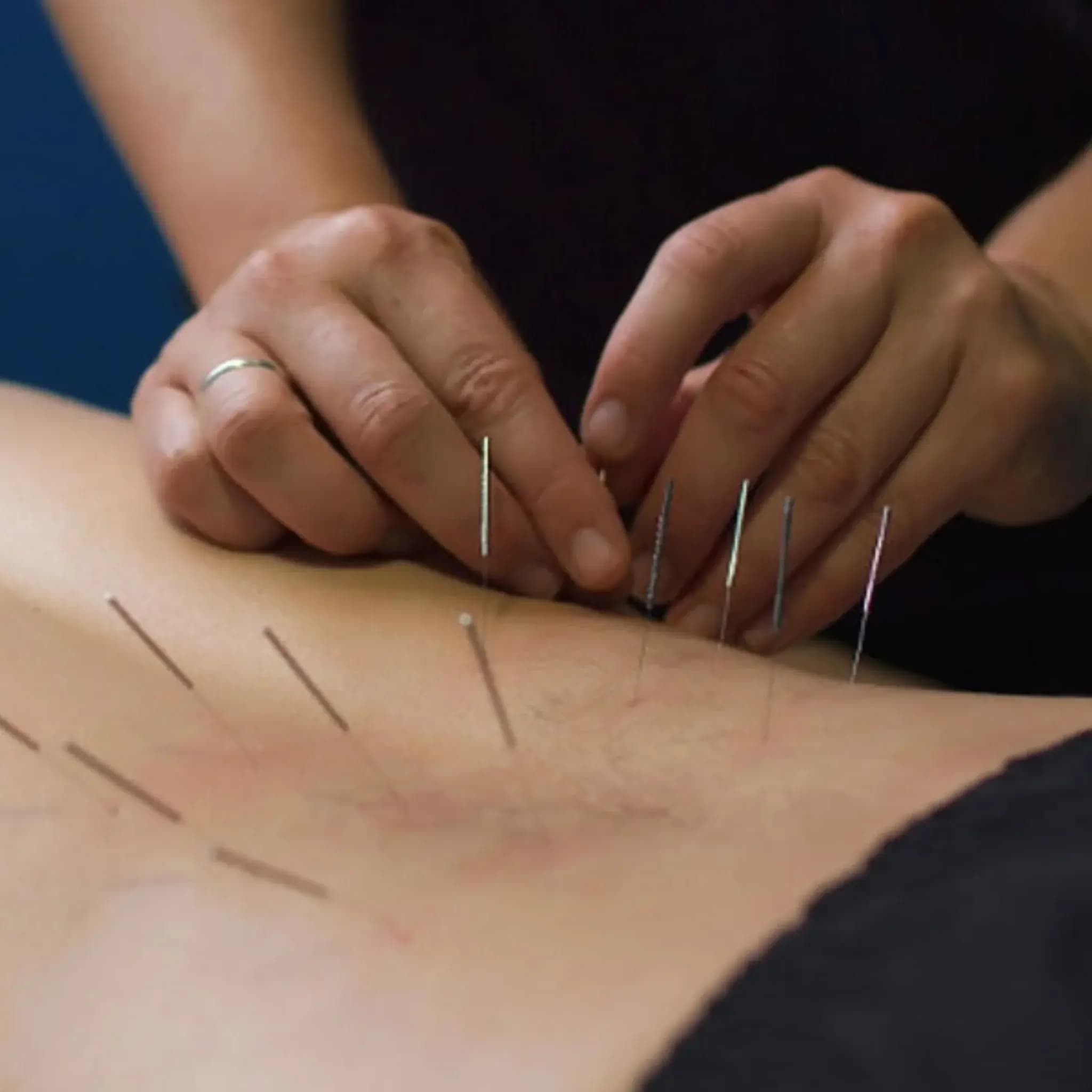 Dry Needling & IMS in NW Calgary at Nolan Hill Physiotherapy & Massage NW Calgary