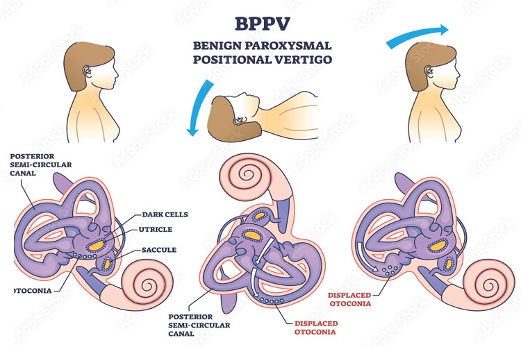 Physiotherapy Interventions For BPPV In Older Adults Challenges And Considerations