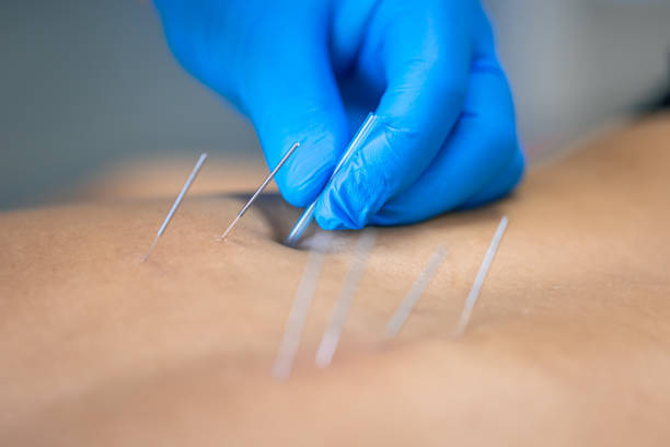 Dry Needling vs. Acupuncture: What’s the Difference?